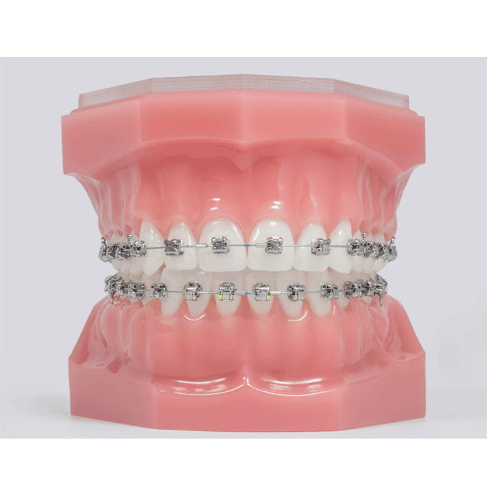 typodont model with damon self ligating braces