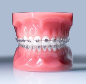 orthodontic demonstrator model with traditional metal braces