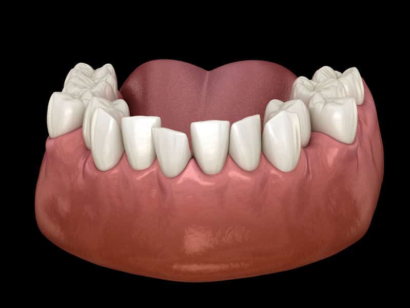 3D rendering of a set of crooked bottom teeth.