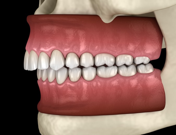 3D rendering of the gums, teeth, jaw and surrounding bone structure.