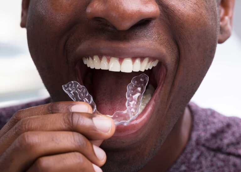 Close up of a man applying a clear aligner tray.