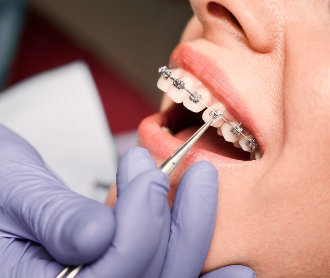 Traditional Braces — Lund Orthodontics
