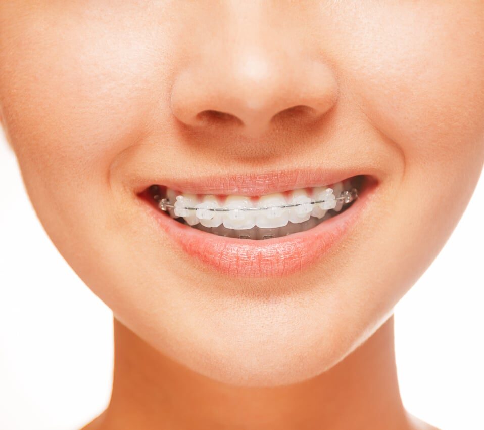 A Girl With Clear Braces