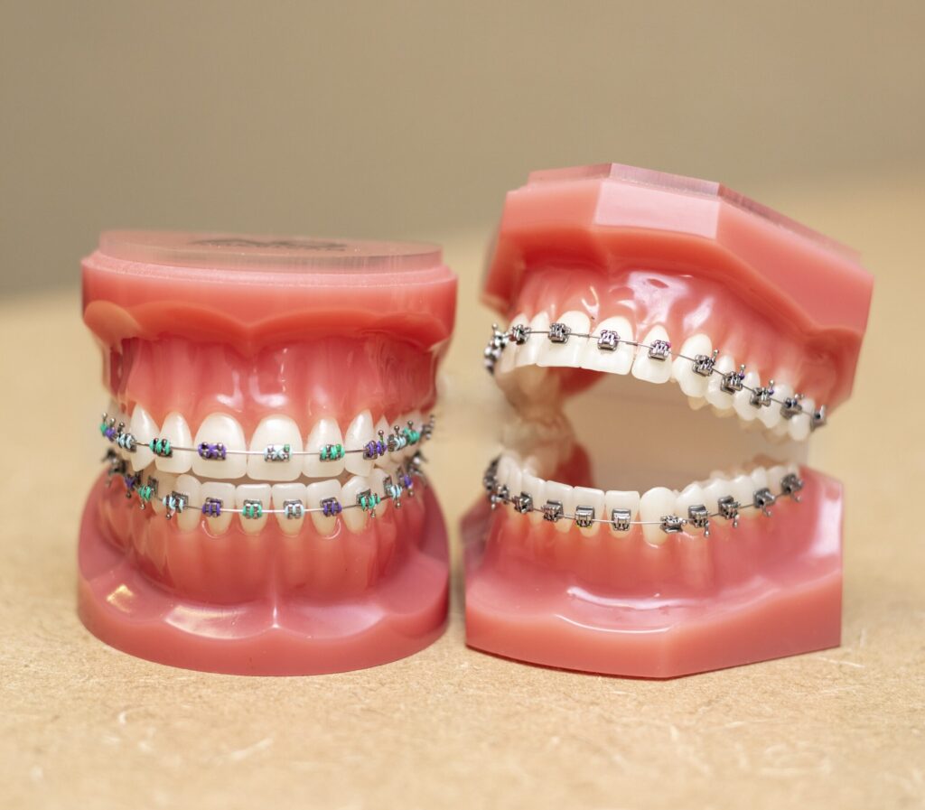 Custom Braces