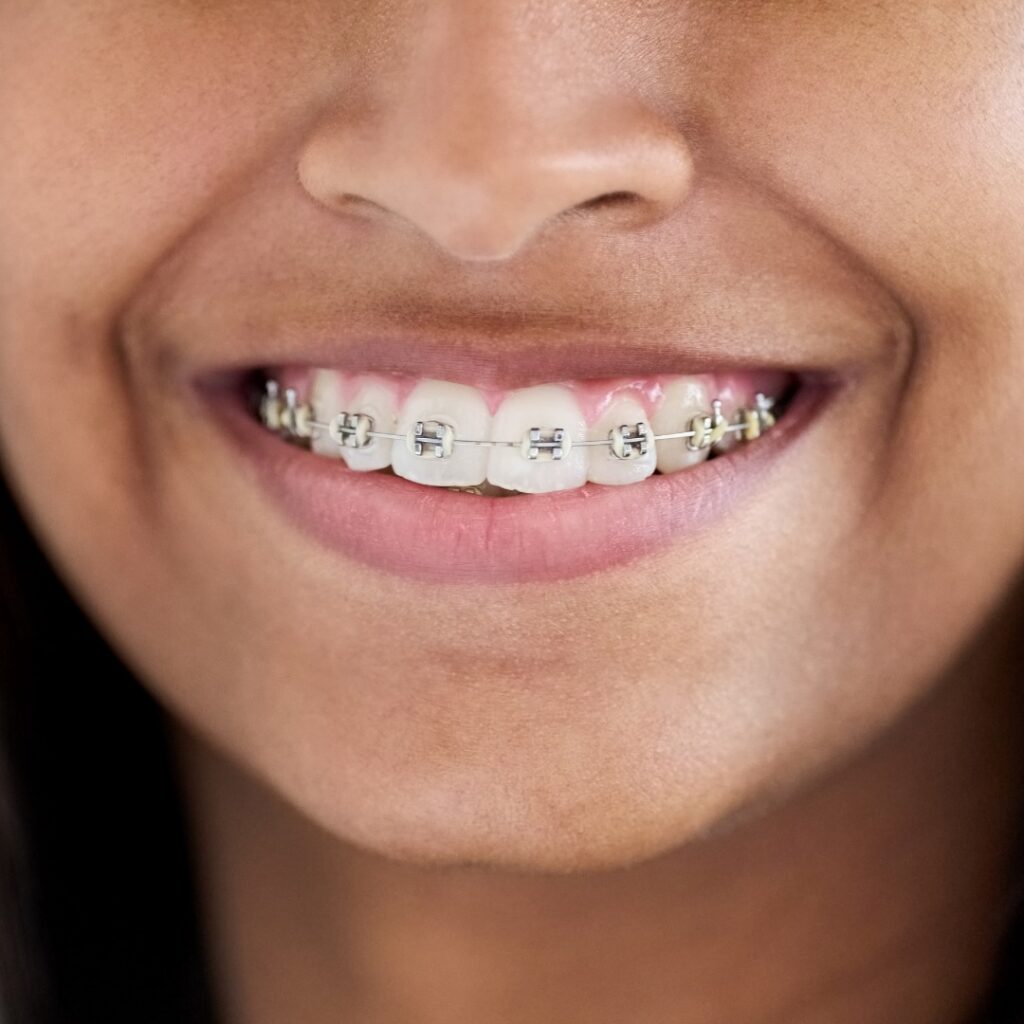 Traditional Metal Braces